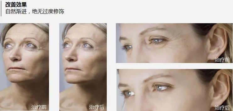 抗衰老的“水光”究竟為何飽受稱贊？