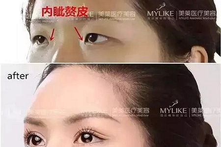 推薦這幾種增大眼睛的方法，除了開(kāi)外眼角！