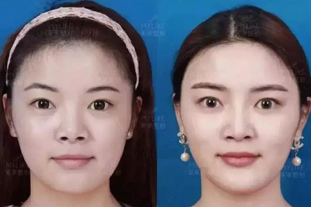 推薦這幾種增大眼睛的方法，除了開(kāi)外眼角！