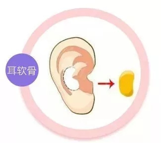 擔(dān)心鼻整形假體透光、發(fā)紅、移位？了解下自體軟骨