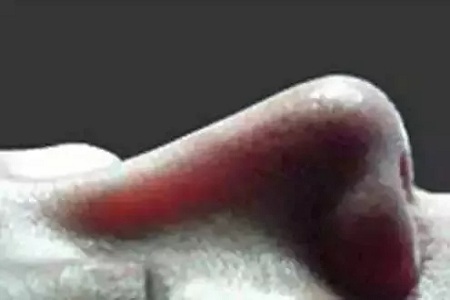 擔(dān)心鼻整形假體透光、發(fā)紅、移位？了解下自體軟骨