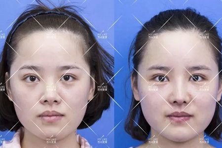 擔(dān)心鼻整形假體透光、發(fā)紅、移位？了解下自體軟骨