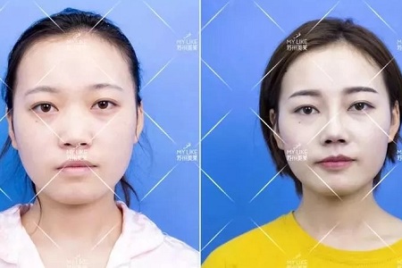 擔(dān)心鼻整形假體透光、發(fā)紅、移位？了解下自體軟骨