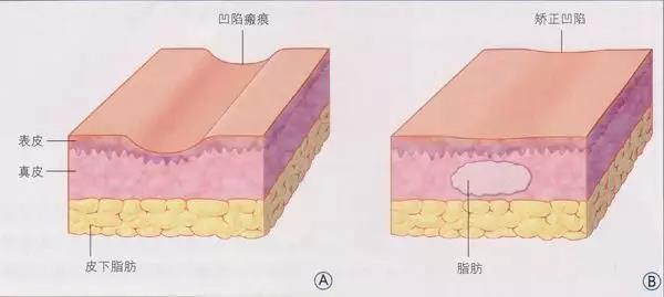 自體脂肪填充為什么需要二次補打？