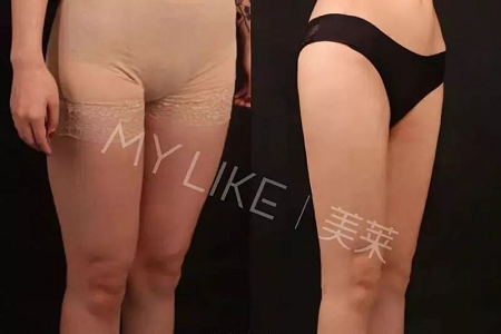 瘦身Flag挑戰(zhàn)賽 | “躺著就能瘦”真的不是夢(mèng)，人人都可以！