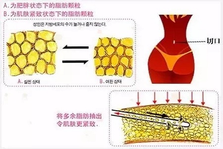 吸脂，怎樣做才算是剛剛好？