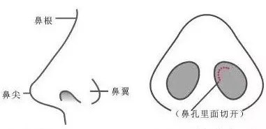 隆鼻手術(shù)切口在哪里？才能自然不留疤