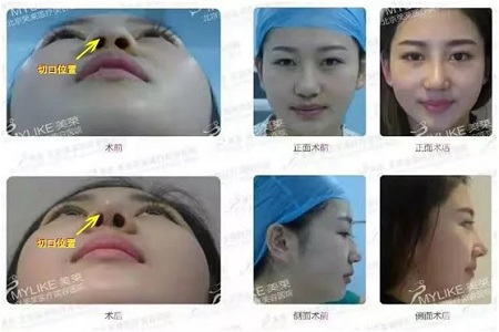 隆鼻手術(shù)切口在哪里？才能自然不留疤