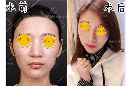 隆鼻手術(shù)切口在哪里？才能自然不留疤