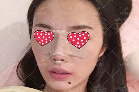 顏值：隆了個(gè)鼻子，男朋友說(shuō)像換了一個(gè)女朋友