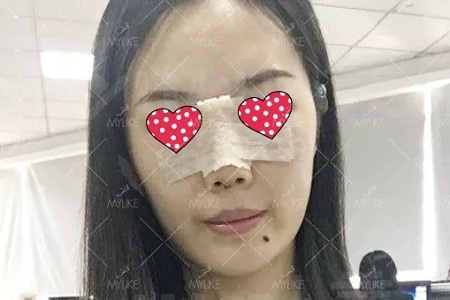 顏值：隆了個(gè)鼻子，男朋友說(shuō)像換了一個(gè)女朋友