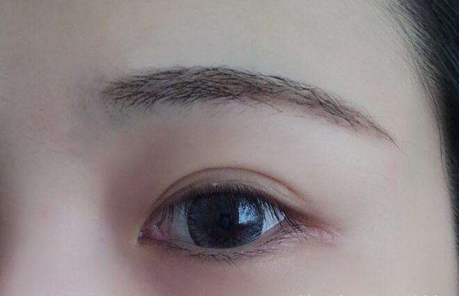 雙眼皮手術(shù)要多少錢？