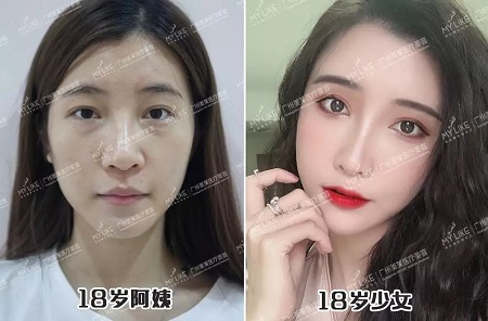 填脂肪21天，老媽竟阻止我相親！why？