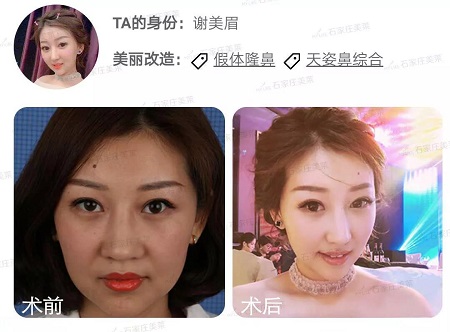 做了假體隆鼻后，變化有多大！看4個案例對比