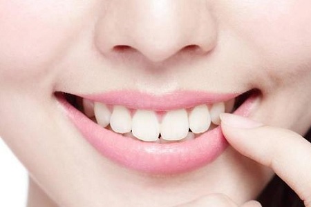 醫(yī)美白皮書：你以為別人潔白整齊的牙齒都是天生嗎？