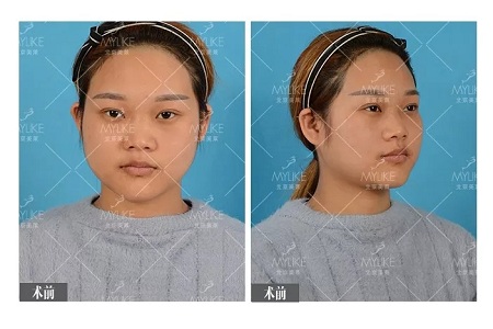 顏值：鼻子的改變能讓一個女孩變化有多大？