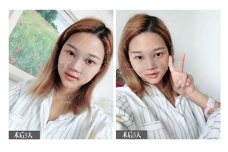 顏值：鼻子的改變能讓一個女孩變化有多大？