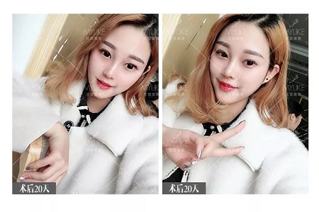 顏值：鼻子的改變能讓一個女孩變化有多大？