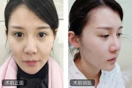 顏值：做完自體脂肪填充15天后，她變啥樣了？
