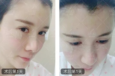 顏值：做完自體脂肪填充15天后，她變啥樣了？
