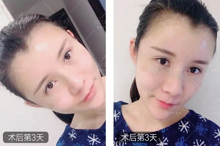 顏值：做完自體脂肪填充15天后，她變啥樣了？