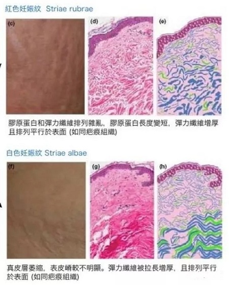 為什么瘦人也會(huì)有“肥胖紋”？