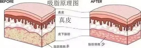 醫(yī)美白皮書(shū)：吸脂等于減肥嗎？