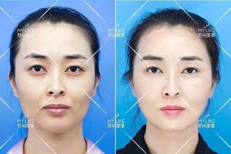你討厭的脂肪，用在臉上就是寶貝！