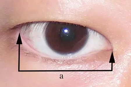 開(kāi)眼角和不開(kāi)眼角，差距有多大？