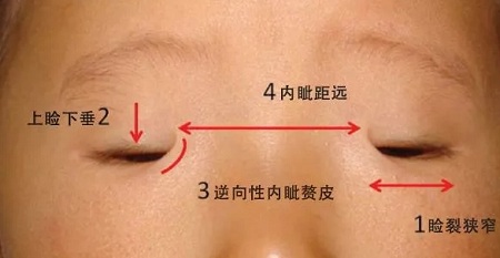 開(kāi)眼角和不開(kāi)眼角，差距有多大？