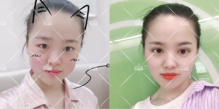 開(kāi)眼角和不開(kāi)眼角，差距有多大？