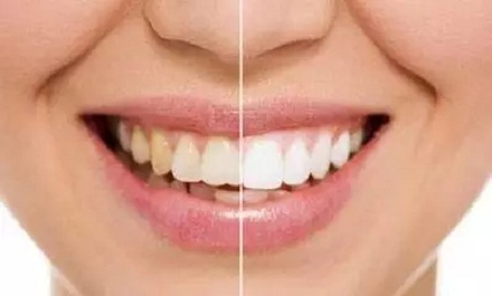 牙齒發(fā)黃怎么辦？還有救嗎？