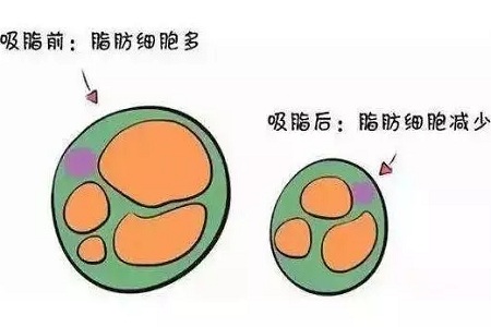 關(guān)于吸脂那些不能說的秘密，今天要在這里一次說完！