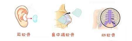 糾結(jié)！鼻頭太圓想塑形是用肋軟骨還是耳軟骨好？