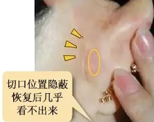 糾結(jié)！鼻頭太圓想塑形是用肋軟骨還是耳軟骨好？
