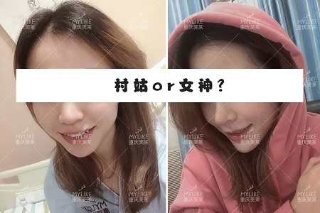 糾結(jié)！鼻頭太圓想塑形是用肋軟骨還是耳軟骨好？