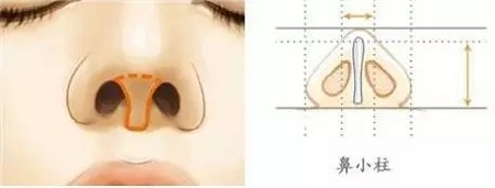 糾結(jié)！鼻頭太圓想塑形是用肋軟骨還是耳軟骨好？