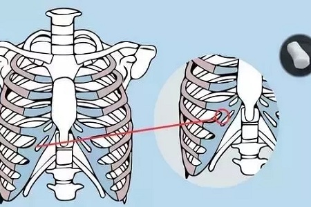 糾結(jié)！鼻頭太圓想塑形是用肋軟骨還是耳軟骨好？