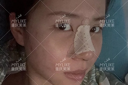 糾結(jié)！鼻頭太圓想塑形是用肋軟骨還是耳軟骨好？