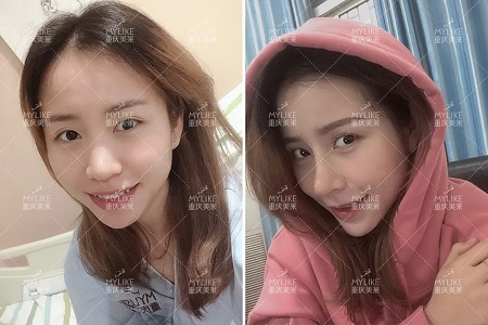 糾結(jié)！鼻頭太圓想塑形是用肋軟骨還是耳軟骨好？