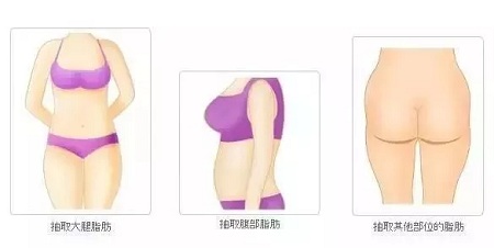 讓明星“一夜回春”的自體脂肪到底適不適合你？