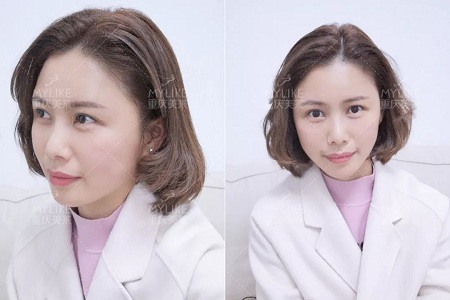 讓明星“一夜回春”的自體脂肪到底適不適合你？