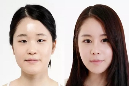 雙眼皮+開眼角為什么是較佳拍檔，一分鐘帶你看懂！