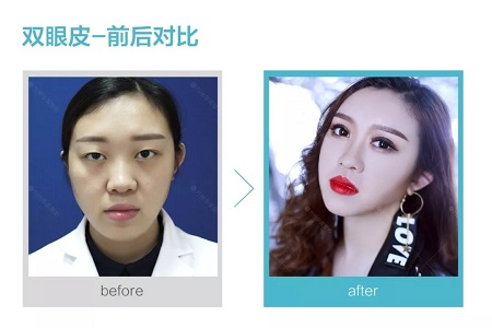 做了雙眼皮，醫(yī)師為什么建議要多睜眼？