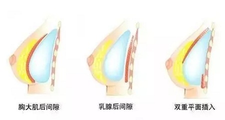 自體脂肪or假體隆胸，我到底應(yīng)該怎么選？