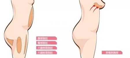 自體脂肪or假體隆胸，我到底應(yīng)該怎么選？