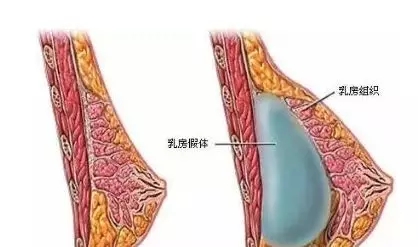 自體脂肪or假體隆胸，我到底應(yīng)該怎么選？