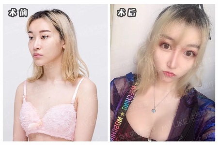 自體脂肪or假體隆胸，我到底應(yīng)該怎么選？
