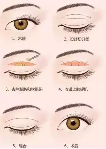 問診室：做雙眼皮前，這些問題你需要提前了解！