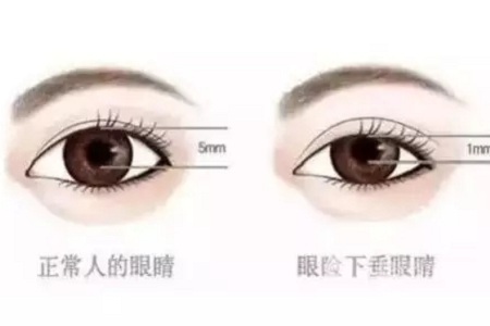 問診室：做雙眼皮前，這些問題你需要提前了解！